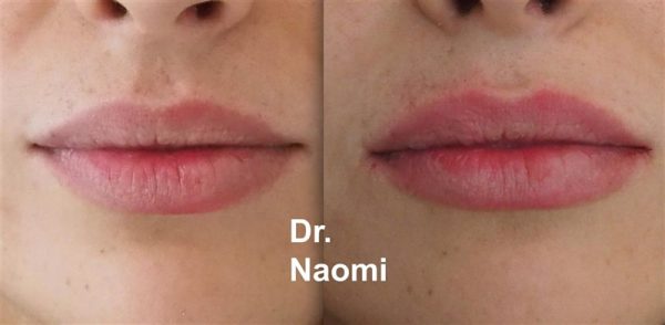 Before and After Lip Treatments