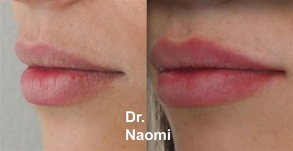 Before and After Natural Result