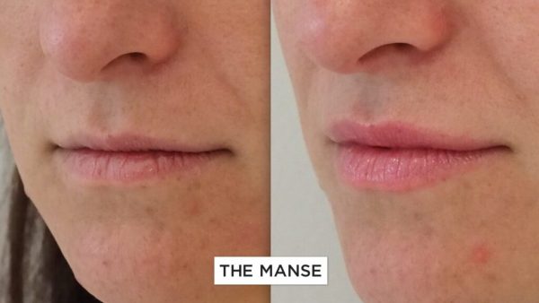 Before and After Treatment for Small Lips