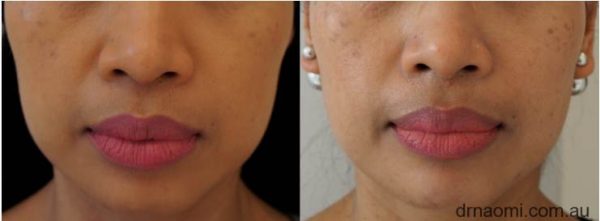 Before and after 1 treatment of jawline reshaping