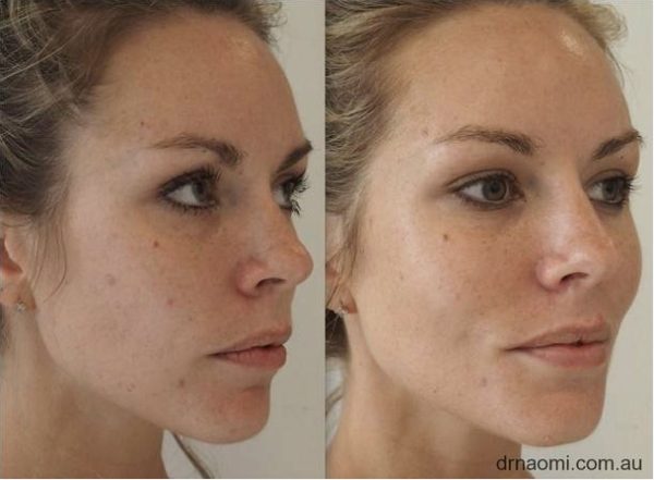 Before and after facial rejuvenation 20 something