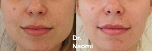 Before and after for jawline slimming. Please note the asymmetry in the jawline in the before photo