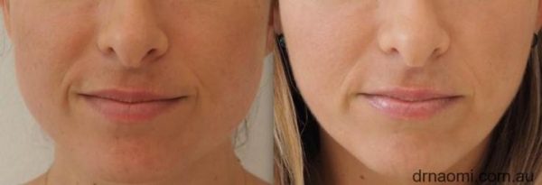 Before and after injections for facial slimming 1 treatment. Symmetry correction