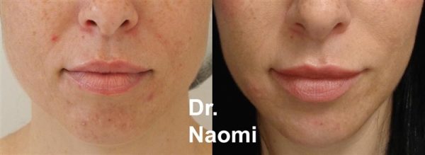 Before and after jawline slimming