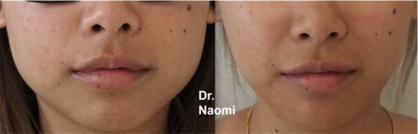 Before and after jawline slimming