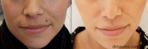 Before and after masseter slimming