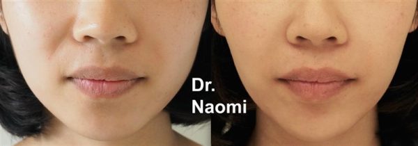 Before and after masseter slimming