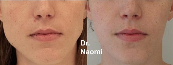 Before and after treatment for bruxism