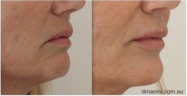 Before and after treatment for downturned mouth and sagging jowls