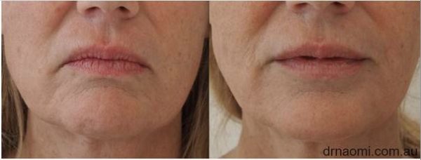 Before and after treatment for lower face jowls and sag