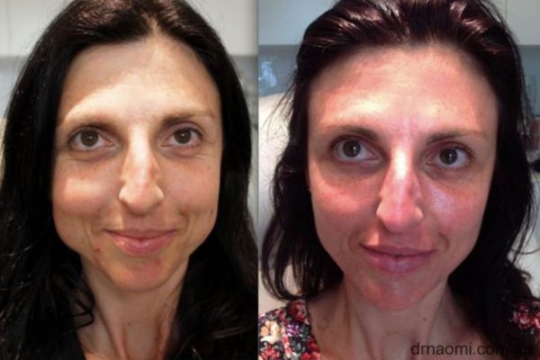 Full Face Rejuvenation
