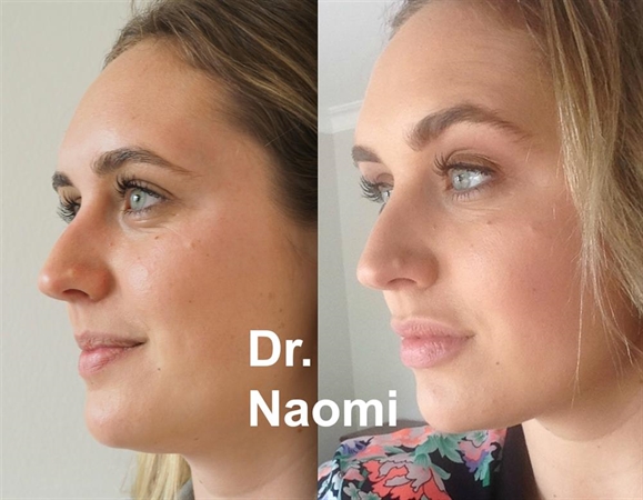 Lip Improvement