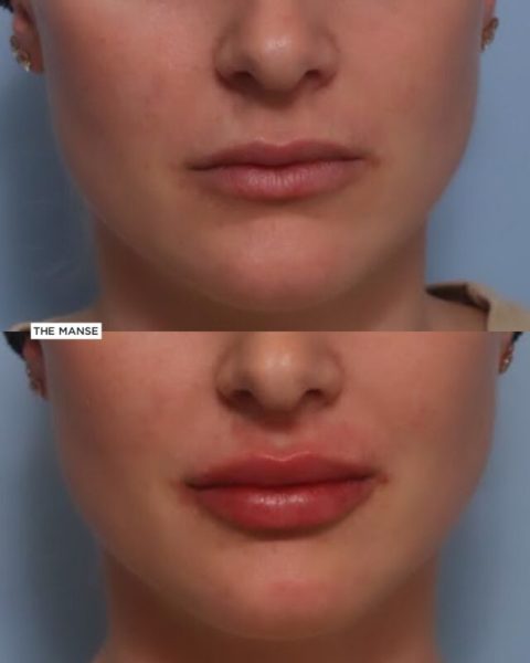 Lip Treatment Before and After