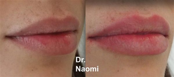 Lip Treatment