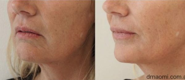Rejuvenation Jawline