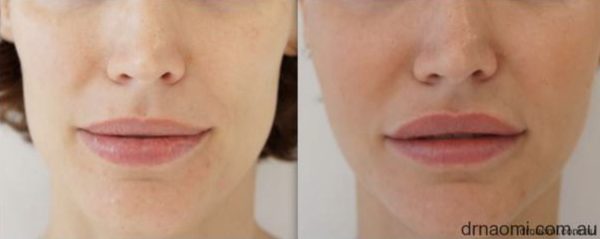 Volumising the face for a younger and prettier face shape