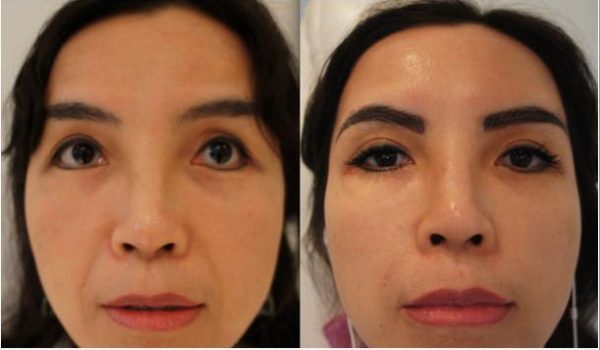 Before and after full face rejuvenation cosmetic clinic