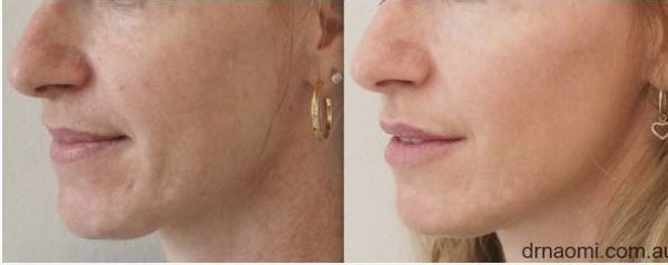 Before and after rejuvenation lips cheeks jowls