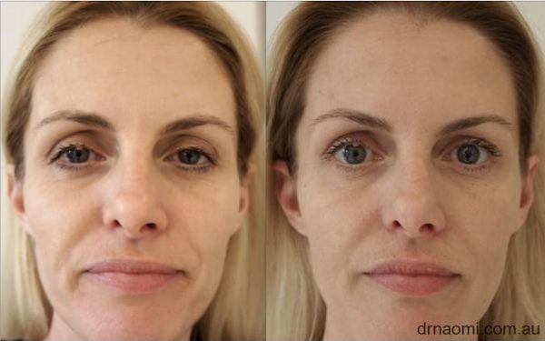 Full face rejuvenation woman in early 40s