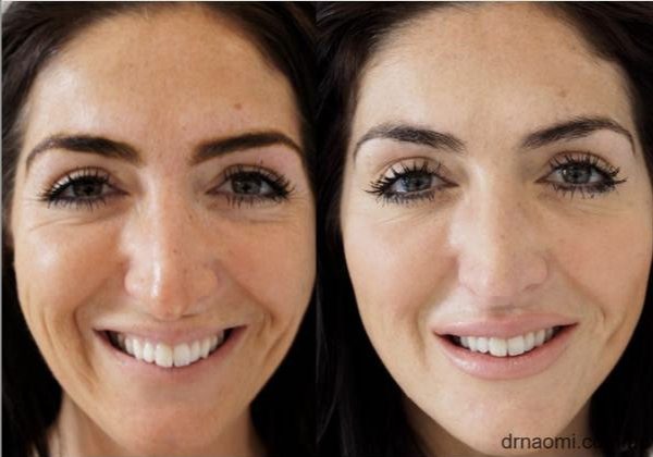 Full face rejuvenation