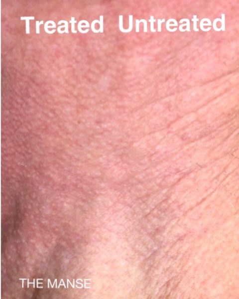 Skin after RF microneedling, IPL laser, skinbooster and biostimulator