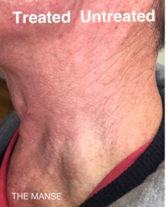 neck skin improvement