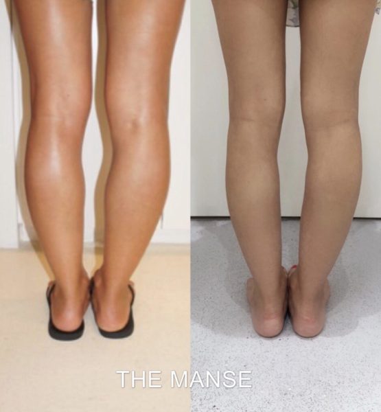 Before and after calf slimming treatments