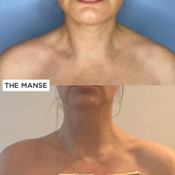 Before and after Trapezius slimming