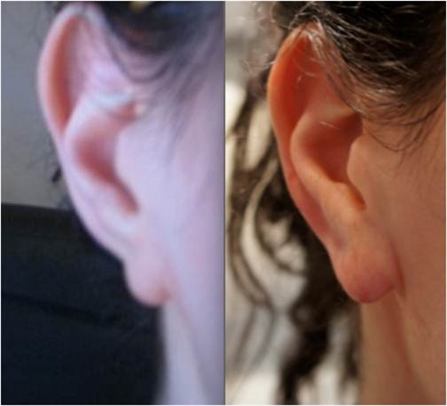 Ear treatment