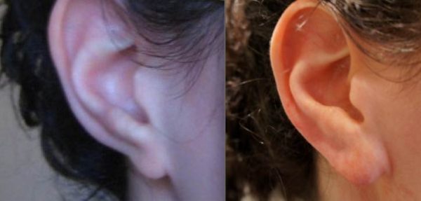 Treatment of ears post surgical problem