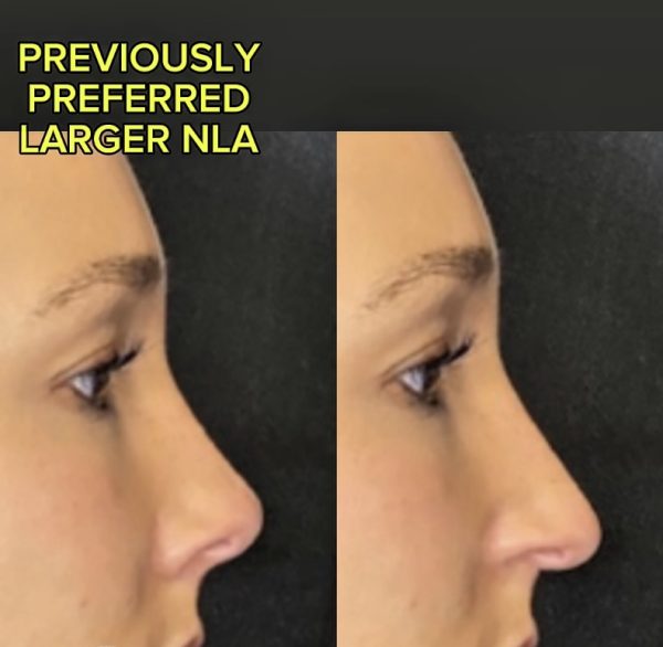 Previously preferred Nasolabial angle