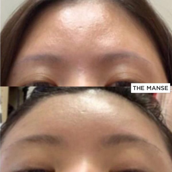 Before and After Forehead Reshaping
