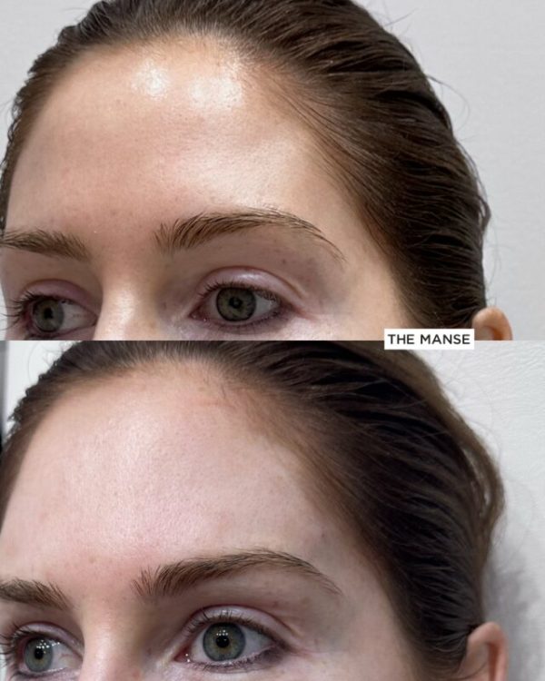 Before and after forehead shape treatment