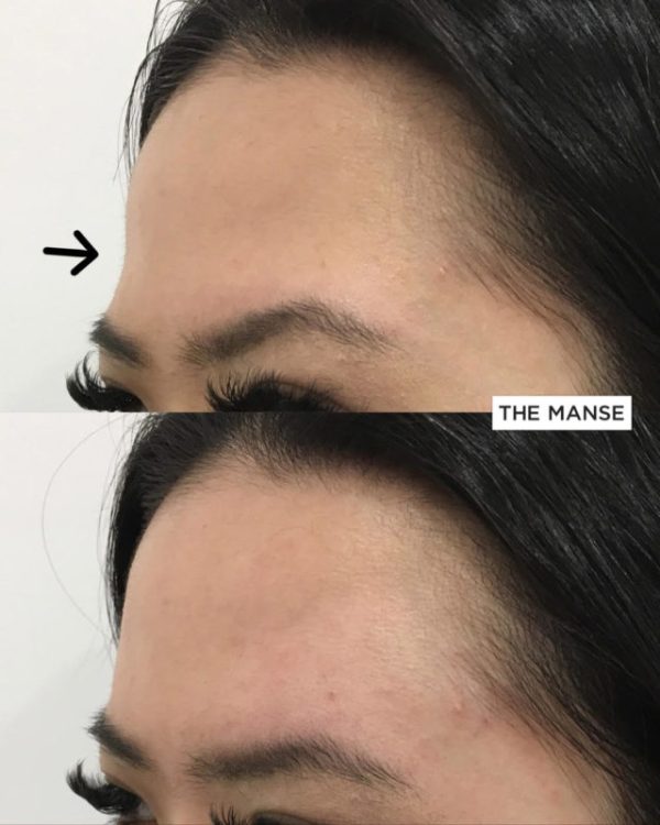 Before and after forehead shape treatment