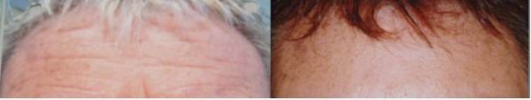 Before and after horizontal forehead lines