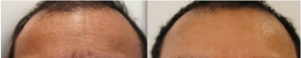 Before and after horizontal forehead lines
