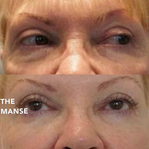 Before and after tear trough and other treatments