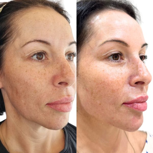 Lower third of face treatment, jawline, chin and marionettes