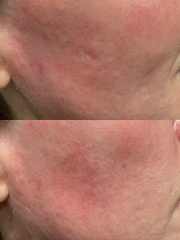 acne scar before and after