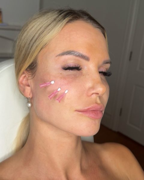 Tear trough treatments